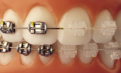 tipos brackets